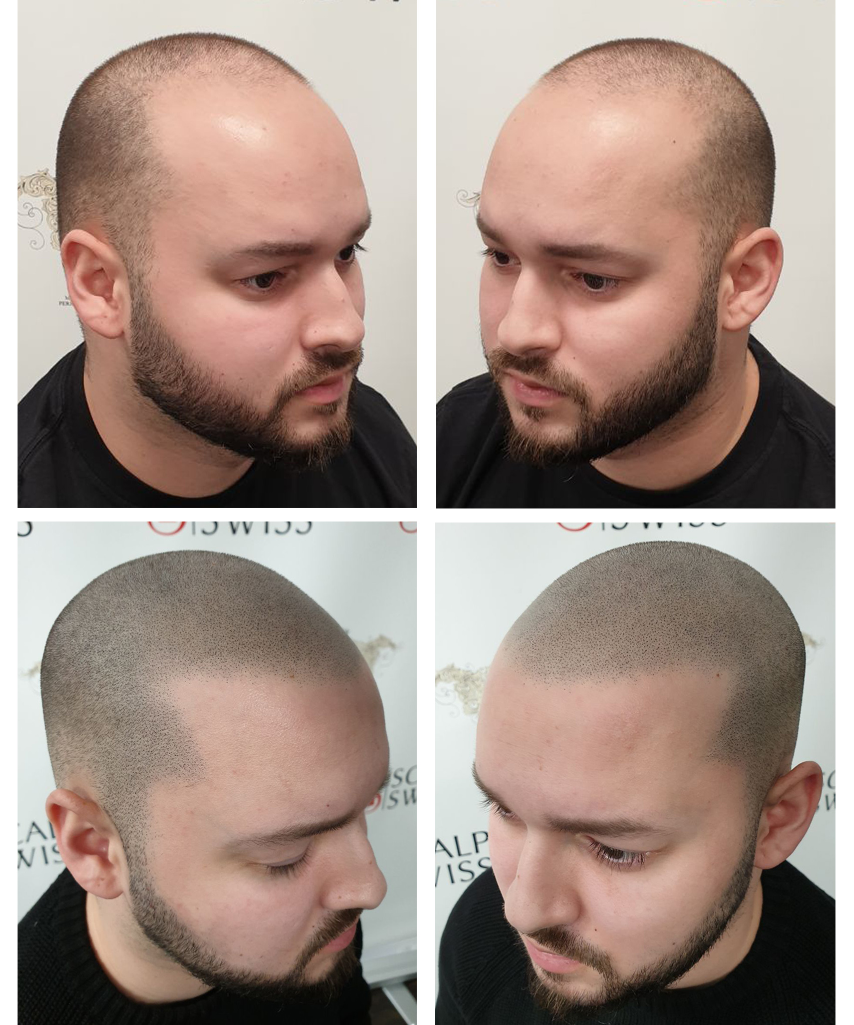 what-is-scalp-micropigmentation